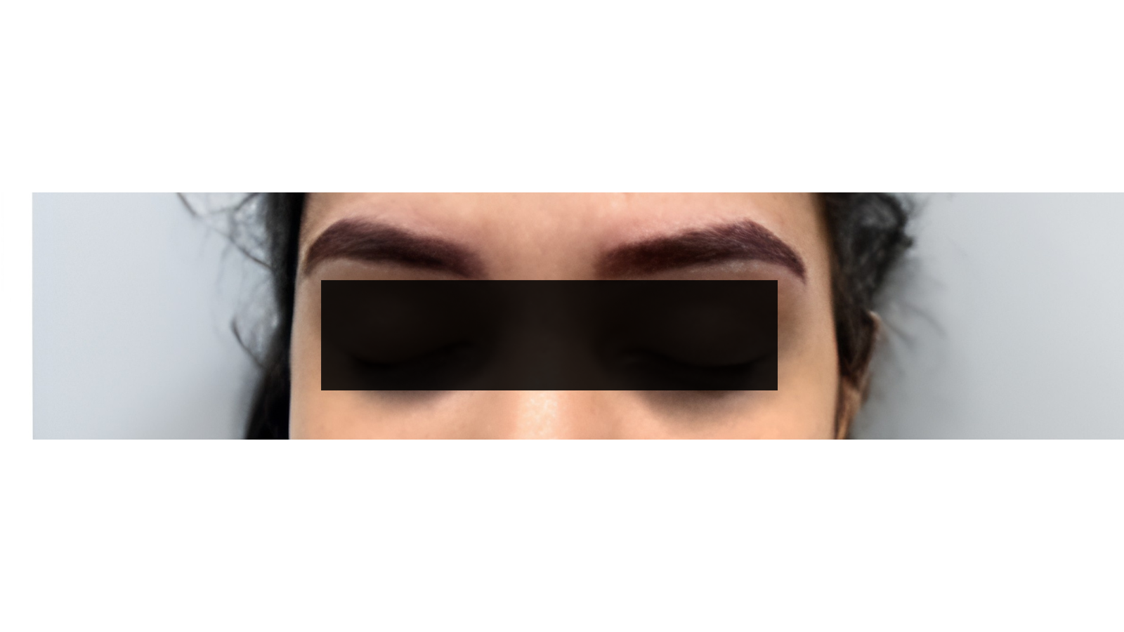 Scalp Micropigmentation after